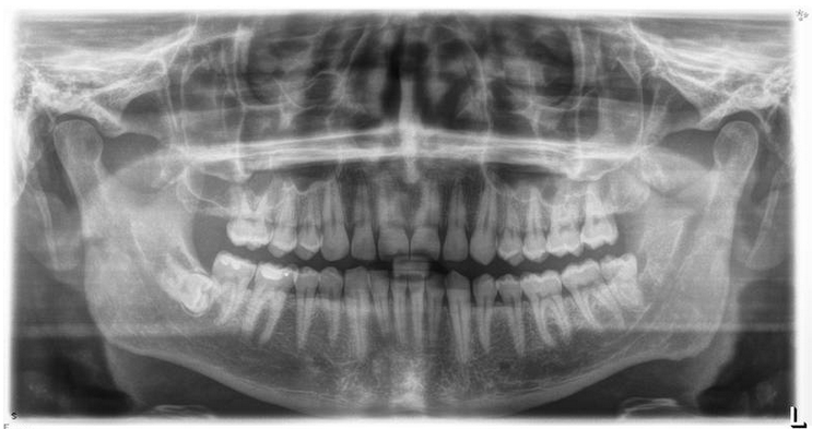 Wisdom teeth X-ray